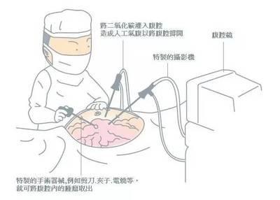 微创技术再上新台阶我院成功开展腹腔镜手术